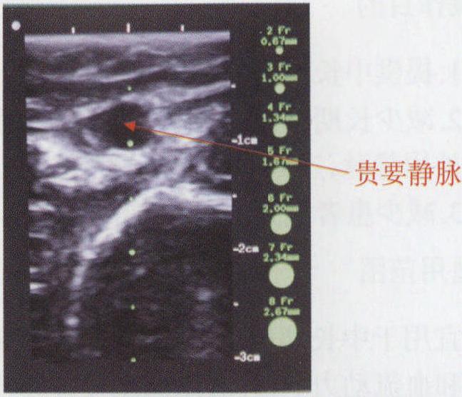 第一節(jié) 超聲引導(dǎo)結(jié)合塞丁格技術(shù)下PICC置管